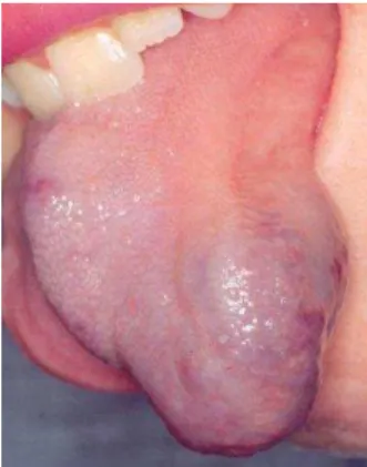 Figura 10 - Hemangioma 