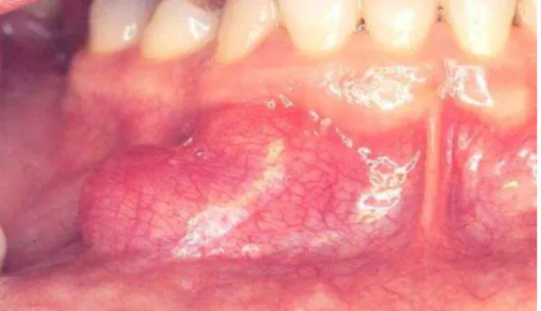 Figura 13 - Neurofibroma 