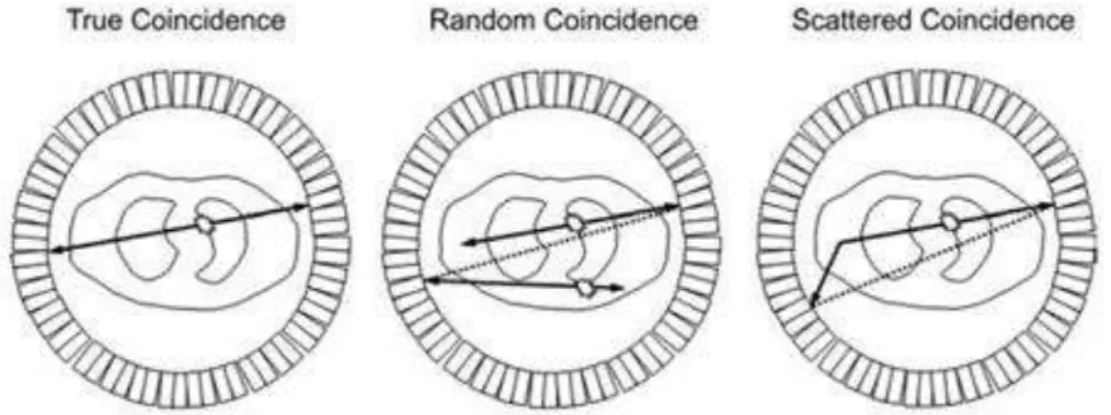Figura 5 Os eventos de coincidência medidos pelo PET podem ser, coincidências verdadeiras  (esquerda), coincidências aleatórias (centro) ou coincidências dispersas (direita).[23]  