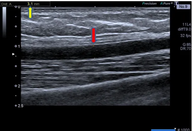 Figura 12 - Imagem ultrassonográfica da artéria braquial após estímulo hiperêmico (modo  bidimensional)
