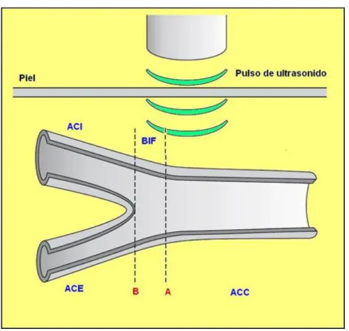 Figura 16 - Ilustração esquemática da artéria carótida comum (ACC), sua bifurcação (BIF) e seus  segmentos interno (ACI) e externo (ACE)