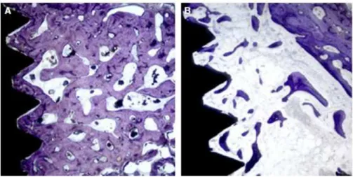 Figura 15 - Análise da interface implante-osso (adaptado de Ocaña et al., 2016). A - Observação de uma  maior formação óssea no grupo I; B - Observação de uma menor formação óssea no grupo II
