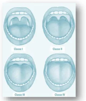 Figura 8- Classificação de Mallampati modificada. Adaptado de Bittencourt et al.2009 