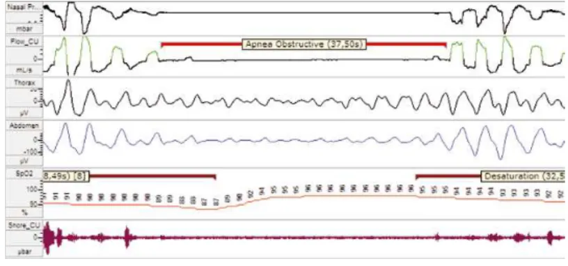 Figura 6  –  Apneia Obstrutiva (Minaritzoglou &amp; Vigiakis, 2008) 