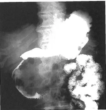 Fig. 1 Alargamento e irregularidade do contorno do arco duo denal, como sinal indirecto em estudo gastro­duodenal, com contraste baritado, num doente com volumosa massa da cabeça do pancreas (adenocarcinoma).