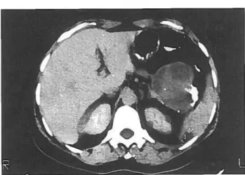 Fig. 8 — Massa da cauda do pâncreas, heterogénea, captando ligei ramente o contraste e.v., co pequenas áreas hipodensas que não captam contraste (pseudoqüí sticas) e calcificações grosseiras à periferia, numa mulher assintomática de 42 anos de idade