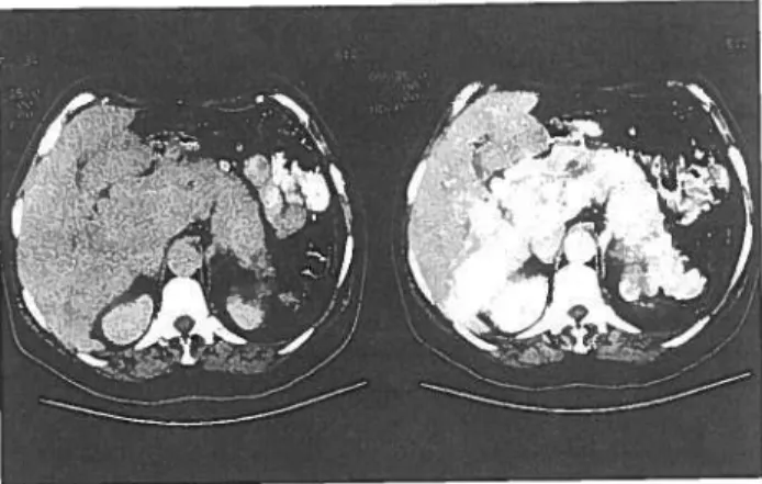 Fig. 9 — Tumor endócrino não funcionante do pâncreas com metástases hepaticas numa mulher assintomática