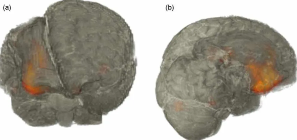 Figure 3 (a and b) Superimposed subtraction of ictal and interictal ECD-SPECT perfusion on the 3D reconstructed MRI showing right orbito-frontal and lateral frontal ictal hyperperfusion.