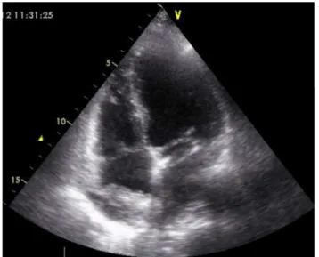 Figure 1 Initial assessment by transthoracic echocardiog- echocardiog-raphy (apical 4-chamber view), showing a heterogeneous echodense image (3 cm × 2.2 cm) adhering to the right atrial roof, interpreted as a thrombus.