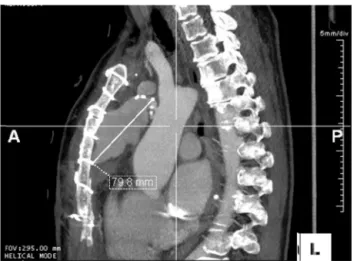 Figure 3 Thoracic computed tomography of the ascending aorta (sagittal plane), showing an image compatible with a large pseudoaneurysm.