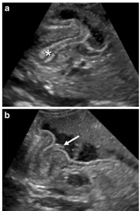 Fig. 6 Abnormal elongation of the pyloric canal (measure 1)
