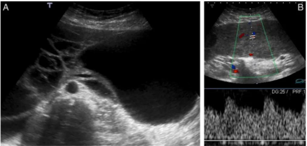 Figure 1 Uterine subserosal leiomyoma with diffuse hydropic degeneration in a 35-year-old woman