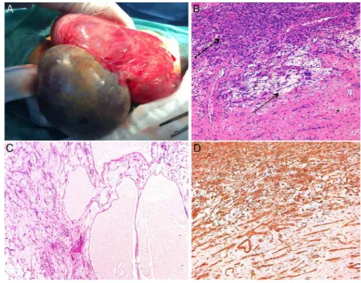 Figure 3 Uterine subserosal leiomyoma with diffuse hydropic degeneration in a 35-year-old woman.
