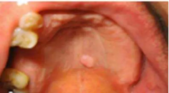Figura 11  –  Papiloma das células escamosas orais localizado no palato.  