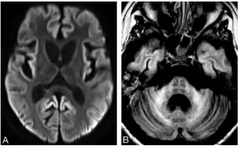 Fig 1. A , Axial diffusion-weighted image shows symmetric striatal and thalamic atrophy and widespread cortical high signal intensity