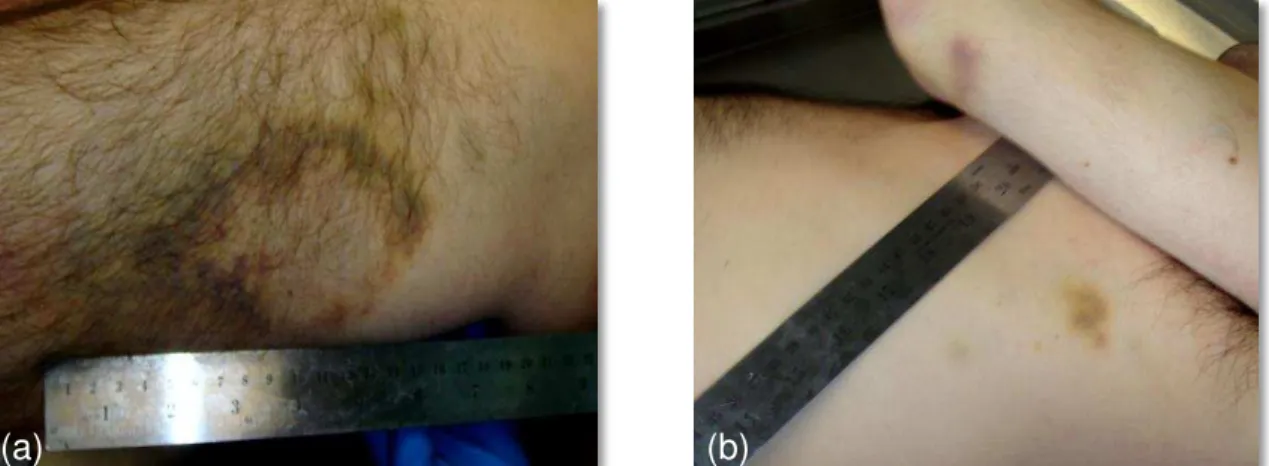 Figura  1.  (a)  Extensa  equimose  em  processo  de  reabsorção.  (b)  Equimoses  de  tonalidades diferentes, produzidas em momentos distintos