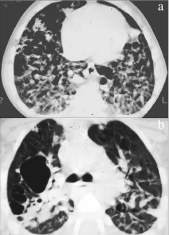 Fig. 4 – Homem de 44 anos; lesão lítica expansiva da mandíbula (região incisiva direita até à região pré-molar homolateral) com erosão das duas corticais e zonas de rotura.