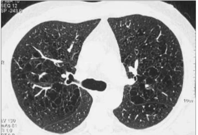 Fig. 6 – Homem de 44 anos, fumador; inúmeras pequenas cavidades quísticas  distribuídas  bilateralmente  correspondentes  à  fase  tardia  da doença pulmonar.