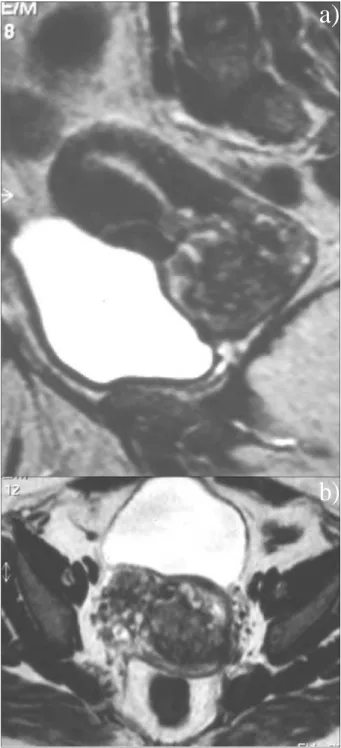 Fig. 14 - Útero didelfus. Axial T2: aspecto normal do colo  com duas