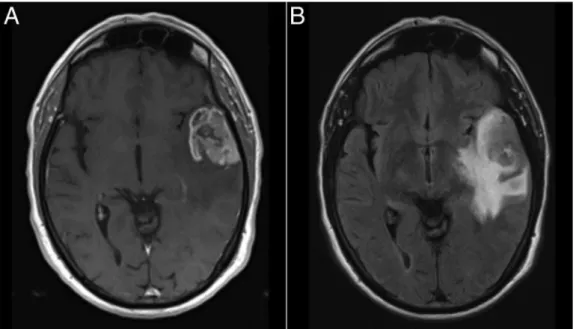 Figure 1 Preoperative brain MRIs. (A) Gadolinium-enhanced T1-weighted axial image showing a lesion in the left temporal lobe with heterogeneous contrast uptake