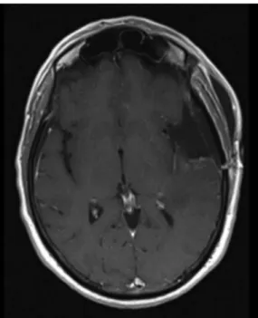 Figure 2 Postoperative brain MRI. Gadolinium-enhanced T1-weighted axial image demonstrating radical tumour excision.