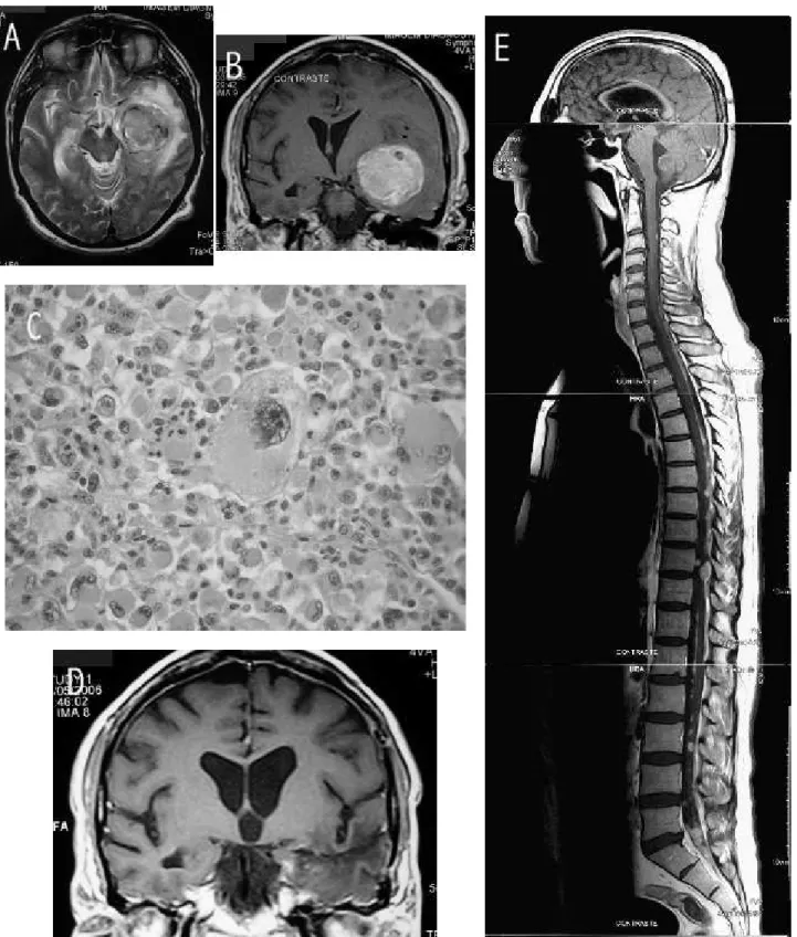 Figure 1. A: preoperative axial T2 weighted MR image; a quite homogeneous subcortical mass in the left temporal lobe with  well deined borders and associated  edema