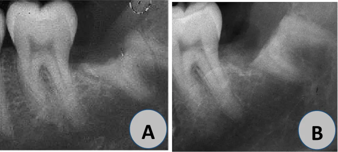 Figura 3- Exame radiográfico; (A) – Exame radiográfico antes das suturas. A seção da coroa necessita de  ser corrigida devido á presença de uma ponta de esmalte situada a mesial do dente