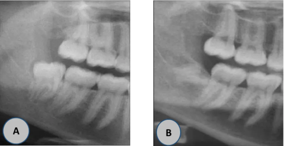 Figura 4- Radiografia pré e pós-operatória; (A) Radiografia pré-operatória do 3M disto angular direito,  com alto risco de lesão do nervo; (B), Radiografia das raízes aos 42 meses com uma migração de 45% 