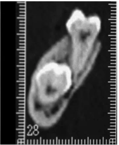 Figura 6- Fase 0 - No caso de suspeita de contacto entre a raiz e o canal mandibular,   então a tomografia deverá ser realizada