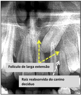 Figura 10- Vista panorâmica de uma paciente com 12 anos de idade, com um canino incluso superior  esquerdo no palato; (Setas amarelas) Em torno da coroa existe um folículo dentário de larga extensão; 