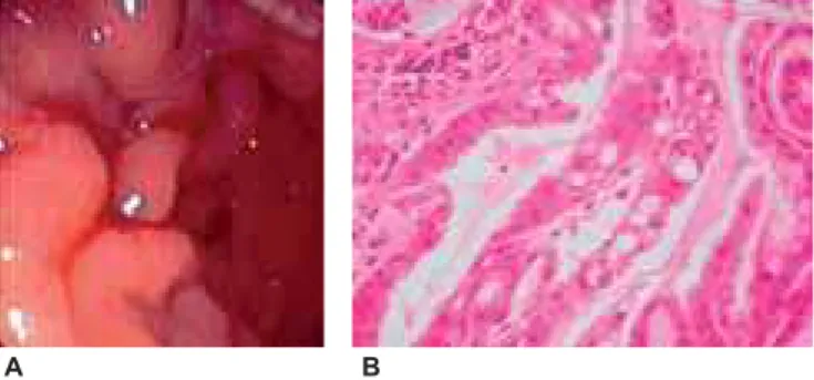 Figura 1 – (A) Endoscopia digestiva alta revelando hipertrofia das pregas e edema da mucosa, Presença de muco e focos de erosão gástrica