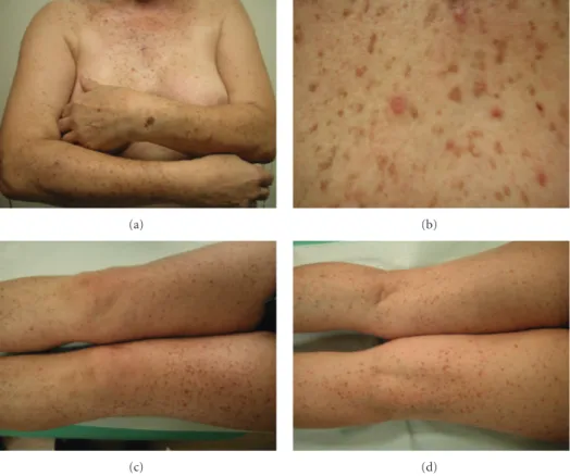 Figure 1: Polymorphous dermatosis characterized by disseminated erythematous papules and plaques and multiple brown macules.