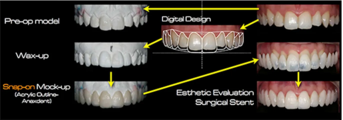 Figura  22:  Planificaçao  do  tratamento  com: Contorno dentes superiores, 