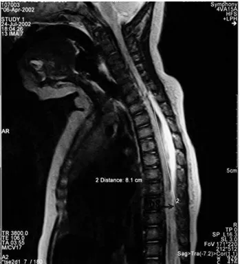 Figura 1 – Ressonância Magnética inicial: hematoma epidural de C6 a T10, obliterando o espaço subaracnoideu posterior.