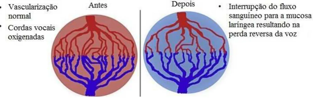 Figura 5 - Efeitos potenciais do bevacizumab na vasculatura da laringe (adaptado de Carter et al., 2015).