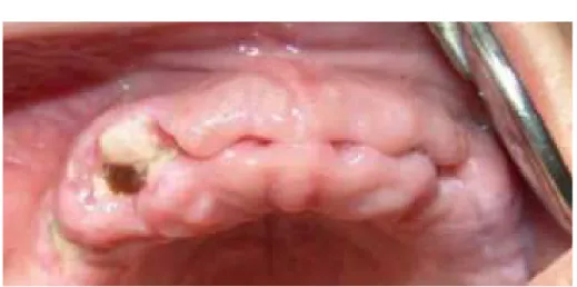 Figura 6   Fotografia intra-oral no pós-cirurgico, com sinais evidentes de exposição óssea no segundo  sextante