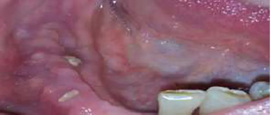Figura 8   Fotografia intra-oral na consulta inicial, com sinais evidentes de exposição óssea