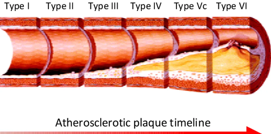 Figure 2: An example of atherosclerotic plaque progression over time (adapted from Koenig &amp; Khuseyinova (2007)).