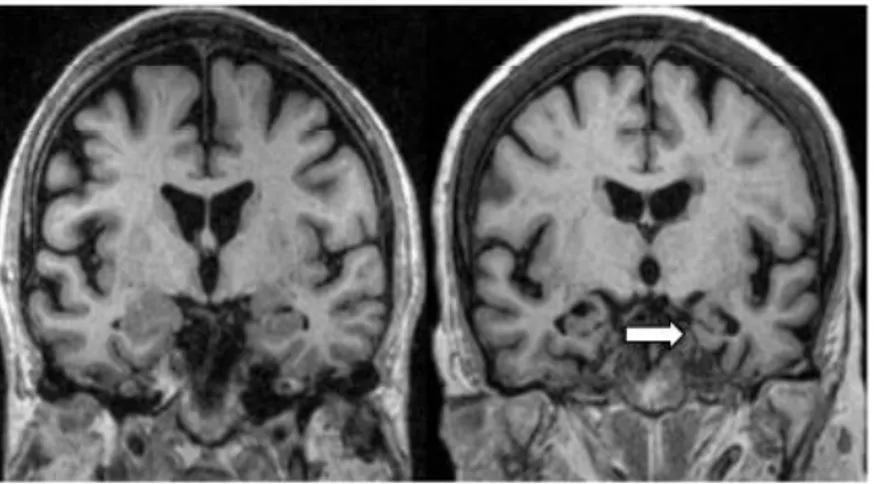 Figura  2.4:  Ressonância  magnética  em  plano  coronal  de  um  controlo  (esquerda)  e  de  um  doente com DA (direita)