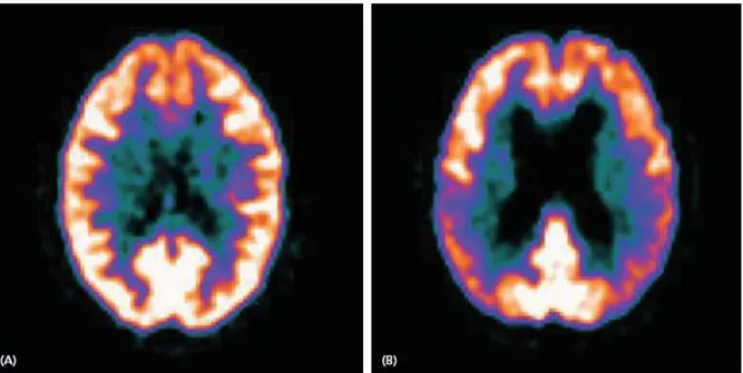 Figura  2.5:  Imagiologia  amiloide  através  de  PET  com  fluorodesoxiglicose  num  indivíduo  normal (A), demonstrando uma retenção mínima e retenção no córtex cerebral de um doente  de Alzheimer (B) Adaptado de Dickson e Weller