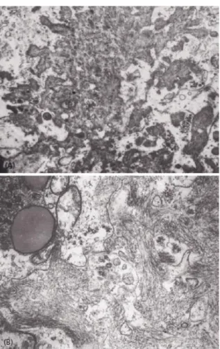 Figura  2.7:  Microscopia  electrónica  de  placas  amiloides  de  núcleo  denso.  Apresentam-se  fibrilhas entrelaçadas de 5-10nm de diâmetro próximas das membranas celulares de células  da microglia