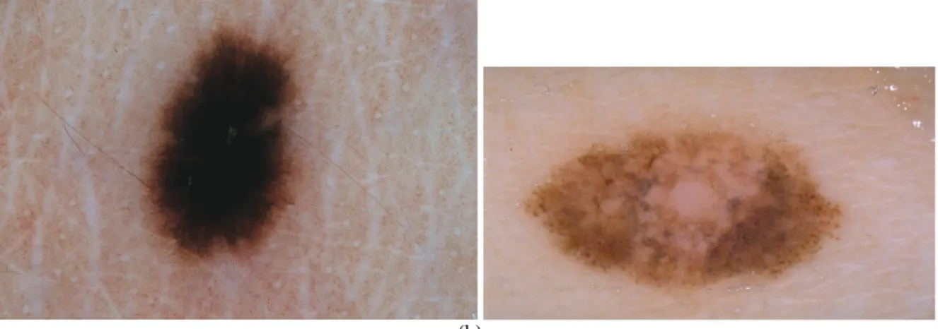 Fig. 1: Skin lesions on dermoscopic images. A (a) benign nevus and a (b) melanoma. 