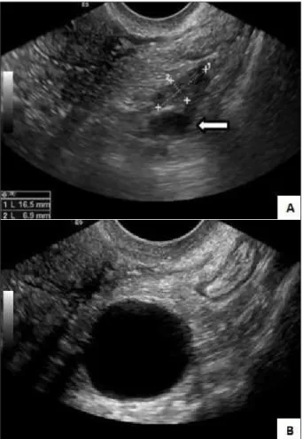 Fig. 5 – Mulher de 25 anos, a fazer anovulatórios. Na ecografia por via transvaginal identifica-se formação quística anexial esquerda com finos ecos em suspensão e vegetações parietais