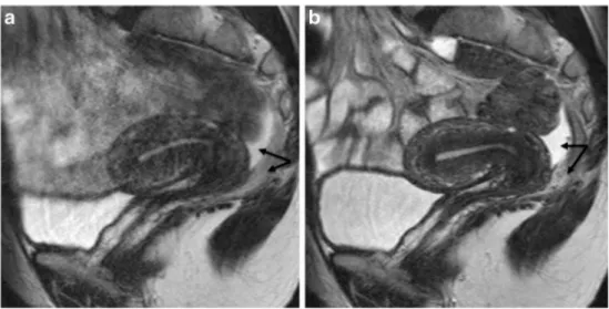 Fig. 2 Sagittal 2D T2-weighted MR images performed at 1.5 Tesla showing the benefits of  anti-peristaltic agents on image quality