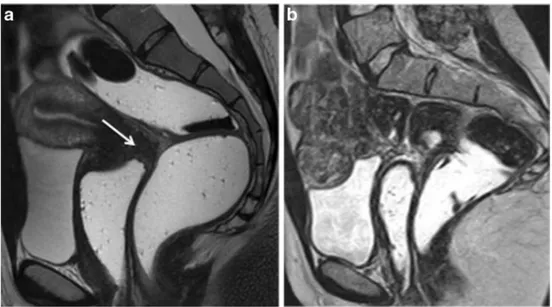 Fig. 4 Sagittal 2D T2-weighted MR images performed in two different patients at 1.5 Tesla following vaginal and rectal opacification with sonographic gel and with (a) or without (b) bowel preparation