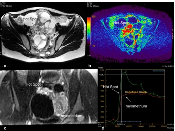 Fig. 3 Technical assessment of DCE MR imaging in complex adnexal masses. This example shows a complex right ovarian mass with a solid component in intermediate T2W signal (a) that heterogeneously enhances after gadolinium injection