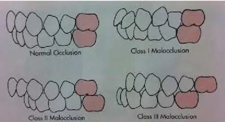 Figura 2 - Normoclusão e classes de má oclusão especificadas por  Angle. Fonte: Proffit, 2000