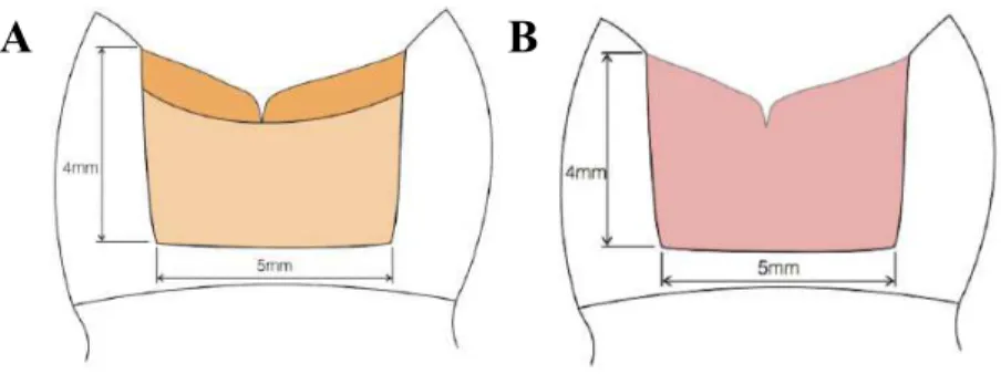 Figura 2 – Técnica “Bulk Fill”, A: Two Step Amalgam-Like Sculpting Technique, B: One Step  Amalgam-Like Sculpting Technique (Adaptada de Hirata et al., 2015)