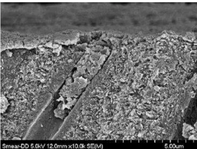 Figura 3 - Imagem obtida por microscopia electrónica de varrimento da smear layer  e smear plug  na dentina (Perdigão, 2007)