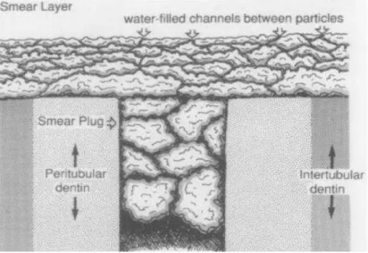 Figura 1  –  Esquema representativo de smear layer e smear plug (adaptada de Pashley e Carvalho, 1997) 